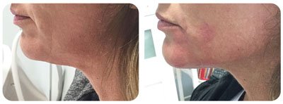 Filler (Chin Augmentation)